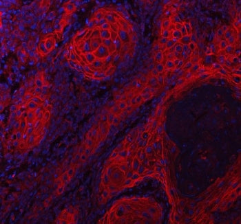 Immunofluorescent staining of FFPE human skin cancer tissue with LYPD3 antibody (red) and DAPI nucle