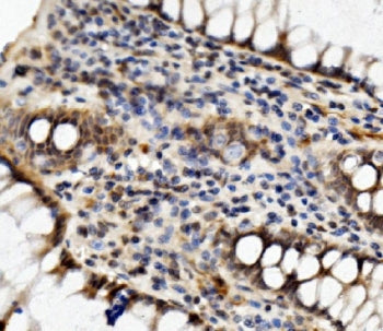 IHC staining of FFPE human rectal cancer with MED4 antibody. HIER: boil tissue sections in pH8 EDTA 