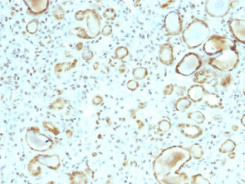IHC staining of FFPE human renal cell carcinoma with STAT3 antibody (clone STAT6/2410). HIER: boil t