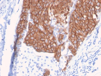 IHC staining of FFPE human breast carcinoma with HER-2 antibody (clone ERBB2/3093). HIER: boil tissu