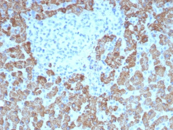 IHC staining of FFPE human hepatocellular carcinoma tissue with CPS1 antibody (clone CPS1/8417). HIE