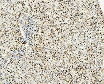 IHC staining of FFPE human liver cancer with PXR/NR1I2 antibody. HIER: boil tissue sections in pH6, 
