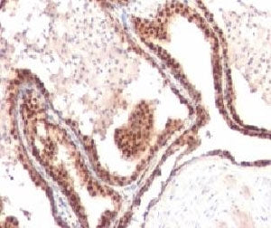 IHC testing of FFPE human prostate cancer and p27Kip1 antibody (clone KIP27-1). Staining of formalin