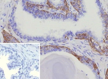 IHC staining of FFPE human prostate cancer tissue with recombinant CK15 antibody (clone KRT15/9088R)