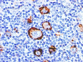 Formalin-fixed, paraffin-embedded human Hodgkin's lymphoma stained with CD15 antibody (clone Leu-M1)