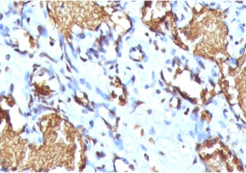 IHC staining of FFPE human angiosarcoma with recombinant Glycophorin A antibody (clone SGPA35-2R). R
