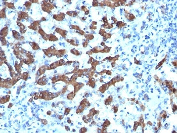 IHC: Formalin-fixed, paraffin-embedded human hepatocellular carcinoma stained with CPS1 antibody (CP