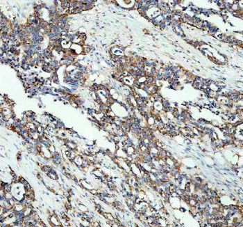IHC staining of FFPE human pancreas cancer tissue with MGST1 antibody. HIER: boil tissue sections in