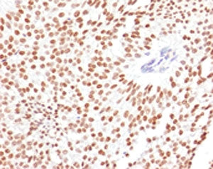 IHC testing of FFPE human bladder carcinoma with FOXA1 antibody (clone FHBA1-1). Staining of FFPE ti