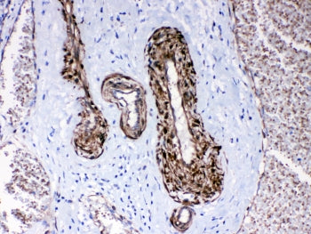 IHC testing of FFPE human lung cancer tissue with CPI-17 antibody at 1ug/ml. Required HIER: steam se