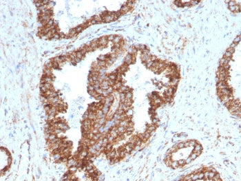 IHC staining of FFPE human prostate carcinoma with TMEPAI antibody (clone PMEPA1/2698). HIER: boil t