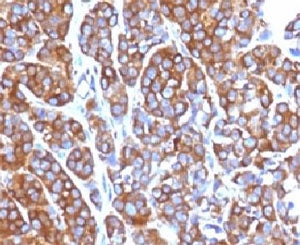 IHC testing of FFPE human melanoma with Moesin antibody (clone EDLP70). HIER: steam section in pH6 c