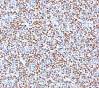 IHC testing of FFPE anaplastic large-cell lymphoma with recombinant ALK antibody (clone ATKR-2R). HI