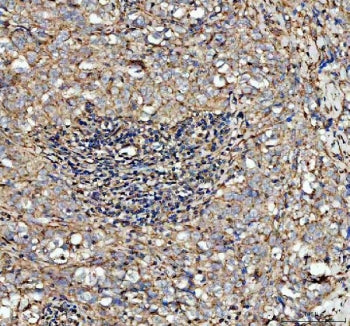 IHC staining of FFPE human breast cancer tissue with CFD antibody. Required HIER: steam section in p