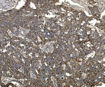 IHC staining of FFPE human ovarian serous adenocarcinoma tissue with Claudin 3 antibody. HIER: boil 