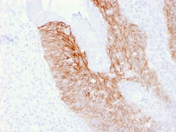 IHC staining of FFPE human cervix carcinoma with CD44v6 antibody (clone 2F10). HIER: boil tissue sec
