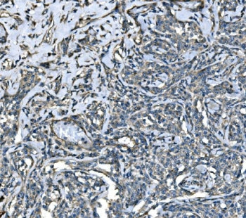 IHC staining of FFPE human lymphoma tissue with Atlastin-1 antibody. HIER: boil tissue sections in p