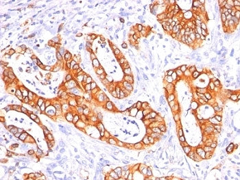 IHC: Formalin-fixed, paraffin-embedded human colon carcinoma stained with MUC-1 / EMA antibody cockt
