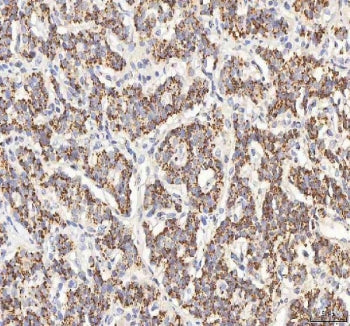 IHC staining of FFPE human lung cancer tissue with BPNT2 antibody. HIER: boil tissue sections in pH8