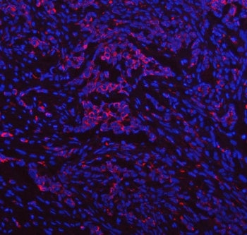 Immunofluorescent staining of FFPE human lung cancer tissue with IDUA antibody (red) and DAPI nuclea