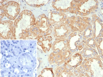 IHC staining of FFPE human kidney carcinoma tissue with HLA-G antibody (clone HLAG/7095). Inset: PBS