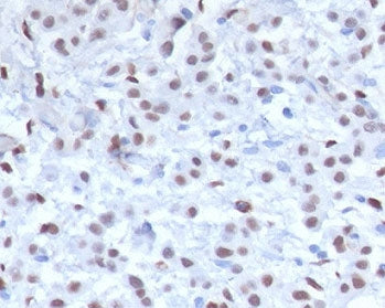 IHC testing of FFPE human mesothelioma with recombinant Wilms Tumor 1 antibody (clone MMWT1-1). Requ