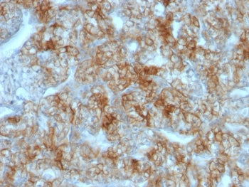 IHC testing of FFPE human renal cell carcinoma with Cadherin 16 antibody (clone CDH16/1071). Require