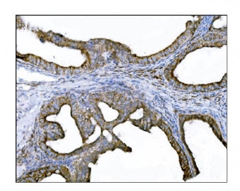 IHC staining of FFPE human ovarian cancer tissue with DLGAP1 antibody. HIER: boil tissue sections in