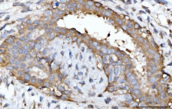 IHC staining of FFPE human breast cancer tissue with GNB3 antibody. HIER: boil tissue sections in pH