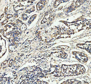 IHC staining of FFPE human lung cancer tissue with CCN1 antibody, HRP-secondary and DAB substrate. H