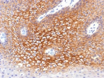 IHC testing of FFPE human cervical carcinoma with Plakoglobin antibody (clone CTNG/1483). Required H
