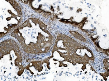 IHC staining of FFPE human ovarian cancer with INPPL1 antibody. HIER: boil tissue sections in pH8 ED
