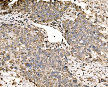 IHC staining of FFPE human liver cancer tissue with LACTB antibody. HIER: boil tissue sections in pH