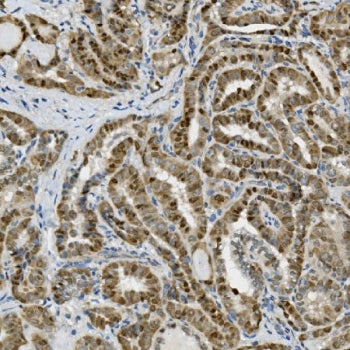 IHC staining of FFPE human thyroid cancer with Transketolase antibody. HIER: boil tissue sections in