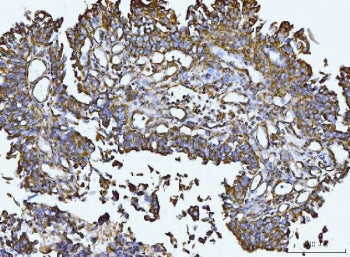 IHC staining of FFPE bladder epithelial carcinoma tissue with Integrin linked protein kinase antibod