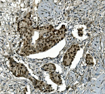 IHC staining of FFPE human breast cancer with Transketolase antibody. HIER: boil tissue sections in 