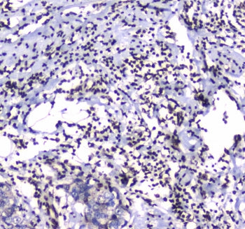 IHC testing of FFPE human breast cancer tissue with GFI1 antibody at 1ug/ml. Required HIER: steam se