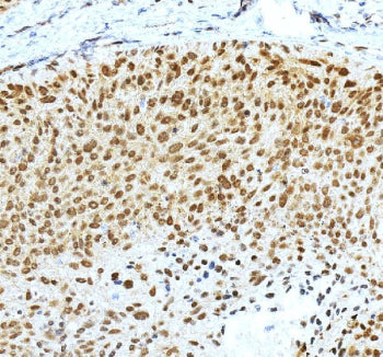 IHC staining of FFPE human skin cancer tissue with Krueppel-like factor 4 antibody, HRP-secondary an
