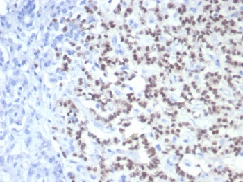 IHC staining of FFPE human pancreatic cancer with PAX6 antibody (clone PAX6/7710). HIER: boil tissue