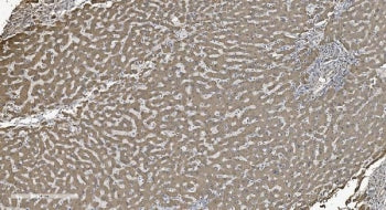 IHC staining of FFPE human liver cancer tissue with SHMT antibody. HIER: boil tissue sections in pH8