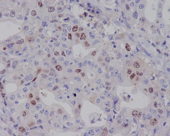 IHC staining of FFPE human gastric carcinoma with BIRC5 antibody. HIER: boil tissue sections in pH6,