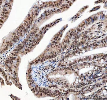 IHC staining of FFPE human rectum adenocarcinoma tissue with ILF2 antibody. HIER: boil tissue sectio