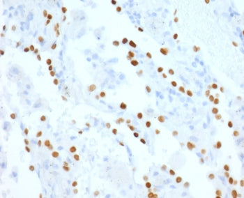 IHC staining of human lung adenocarcinoma with recombinant NKX2.1 antibody (clone HBNK2-2R). Require
