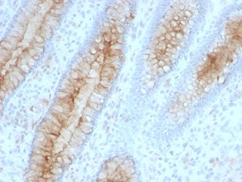 IHC: Formalin-fixed, paraffin-embedded human colon carcinoma stained with Beta-2-Microglobulin antib