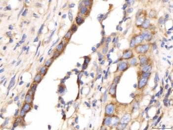 IHC staining of FFPE human colorectal cancer tissue with Myomegalin antibody. HIER: boil tissue sect