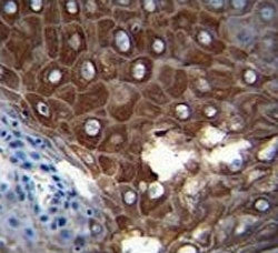 MMP1 antibody immunohistochemistry analysis in formalin fixed and paraffin embedded human esophageal