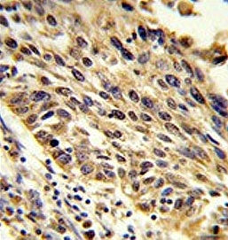 IHC testing of FFPE human lung carcinoma tissue with TRIP13 antibody. HIER: steam section in pH6 cit