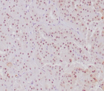 IHC staining of FFPE human MiT translocation RCC with TFE3 antibody. Nuclear staining using TFE3/684