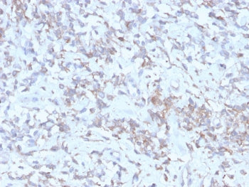 IHC: Formalin-fixed, paraffin-embedded human hepatocellular carcinoma stained with recombinant RBP-1