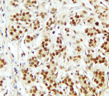IHC staining of FFPE human breast cancer tissue with CTBP2 antibody. HIER: boil tissue sections in p